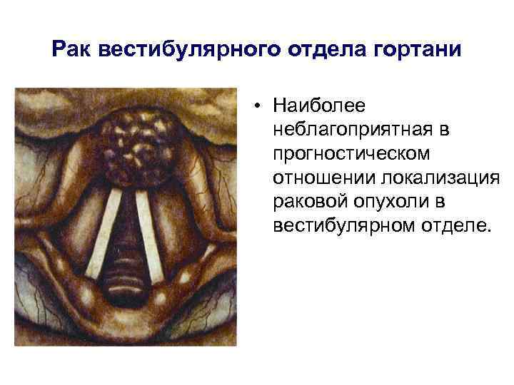 Рак вестибулярного отдела гортани • Наиболее неблагоприятная в прогностическом отношении локализация раковой опухоли в