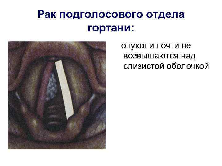 Рак подголосового отдела гортани: опухоли почти не возвышаются над слизистой оболочкой 