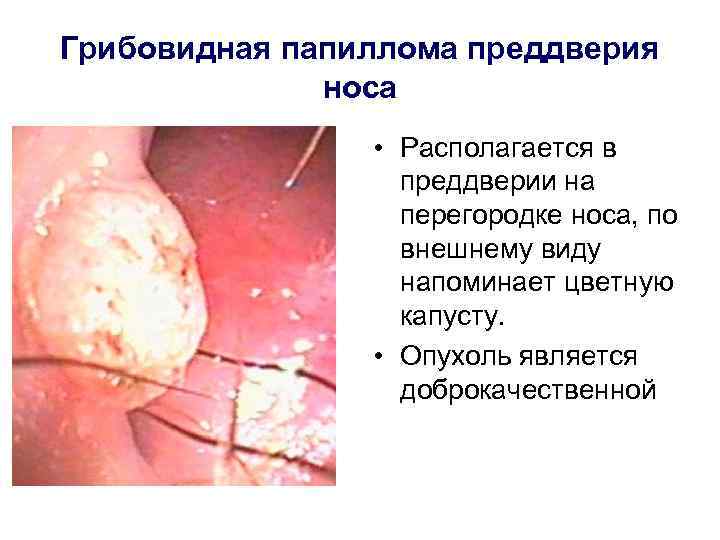 Грибовидная папиллома преддверия носа • Располагается в преддверии на перегородке носа, по внешнему виду