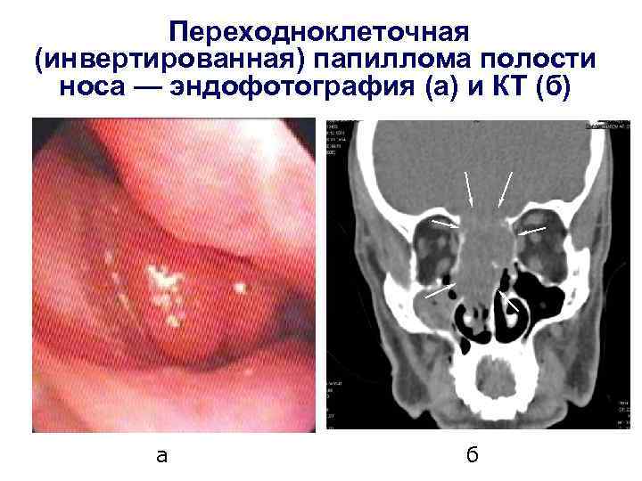 Переходноклеточная (инвертированная) папиллома полости носа — эндофотография (а) и КТ (б) а б 