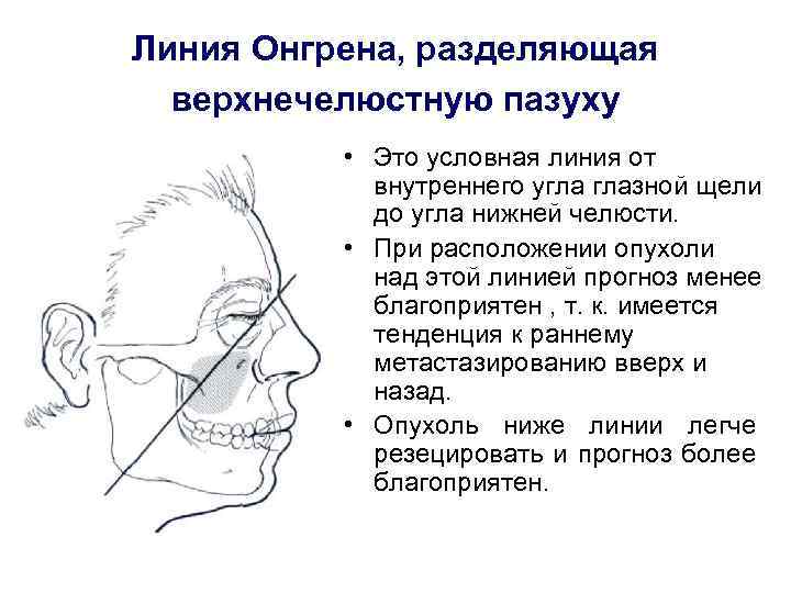 Линия Онгрена, разделяющая верхнечелюстную пазуху • Это условная линия от внутреннего угла глазной щели