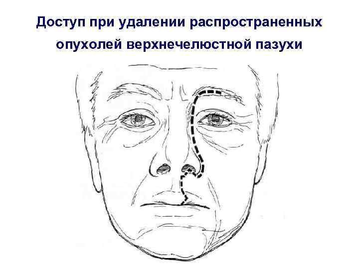 Доступ при удалении распространенных опухолей верхнечелюстной пазухи 