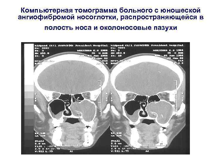 Компьютерная томограмма больного с юношеской ангиофибромой носоглотки, распространяющейся в полость носа и околоносовые пазухи