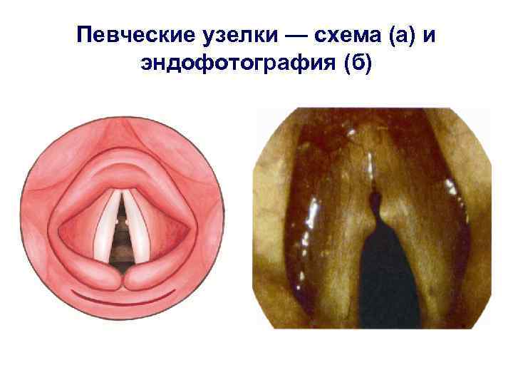 Певческие узелки — схема (а) и эндофотография (б) 