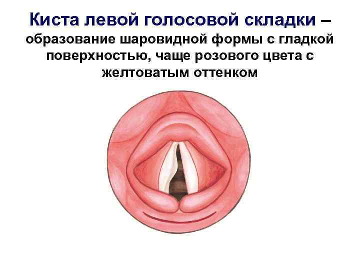 Киста левой голосовой складки – образование шаровидной формы с гладкой поверхностью, чаще розового цвета