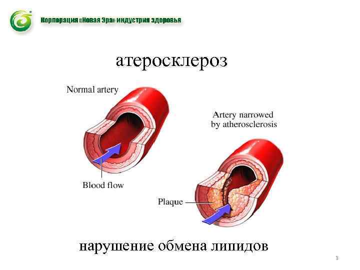 атеросклероз нарушение обмена липидов 3 