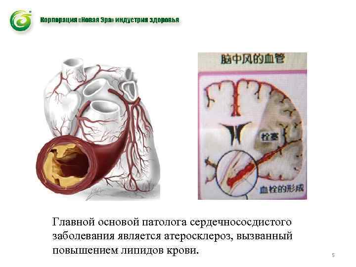Главной основой патолога сердечнососдистого заболевания является атеросклероз, вызванный повышением липидов крови. 5 