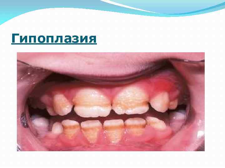 Гипоплазия 