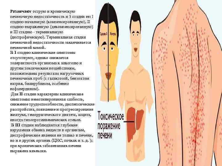 Различают острую и хроническую печеночную недостаточность и 3 стадии ее: I стадию-начальную (компенсированную), II