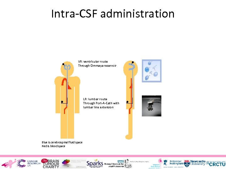 Intra-CSF administration VR: ventricular route Through Ommaya reservoir LR: lumbar route Through Port-A-Cath with