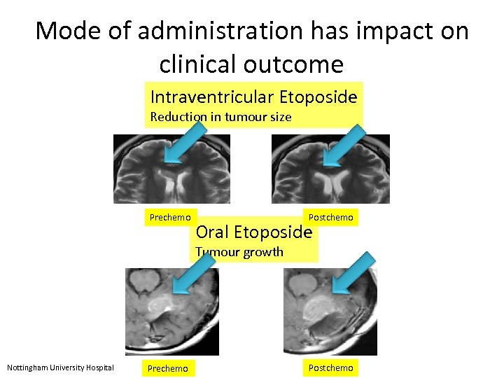 Mode of administration has impact on clinical outcome Intraventricular Etoposide Reduction in tumour size