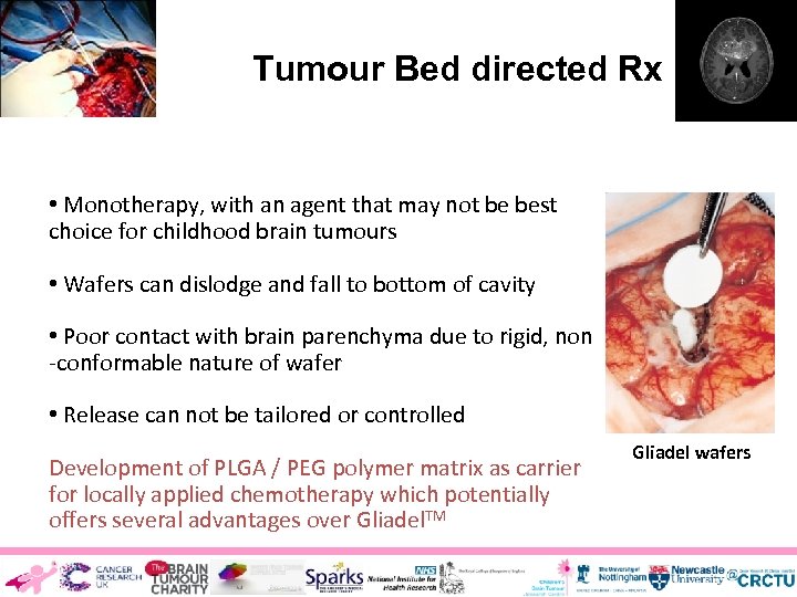 Tumour Bed directed Rx However : • Monotherapy, with an agent that may not