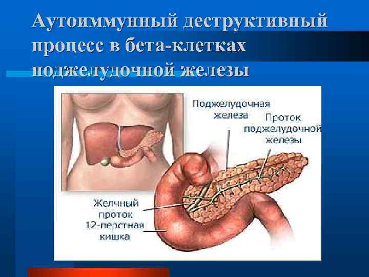 Аутоиммунный деструктивный процесс в бета-клетках поджелудочной железы 