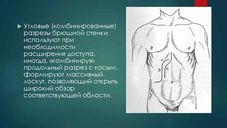  Угловые (комбинированные) разрезы брюшной стенки используют при необходимости расширения доступа, иногда, «комбинируя» продольный