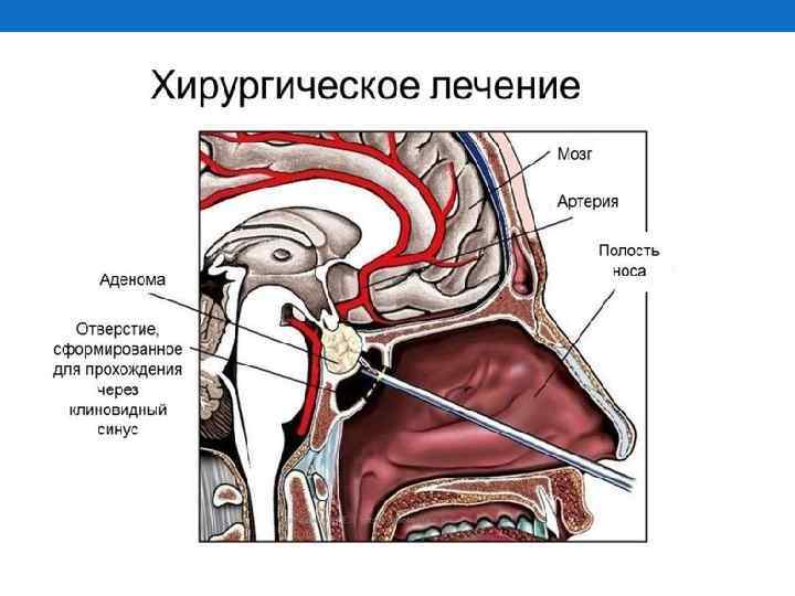 Болезнь иценко кушинга фото больных