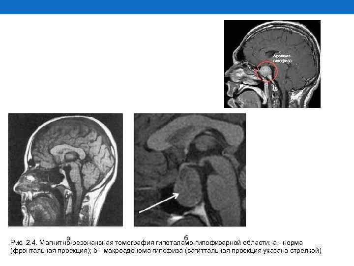 Рис. 2. 4. Магнитно-резонансная томография гипоталамо-гипофизарной области: а - норма (фронтальная проекция); б -