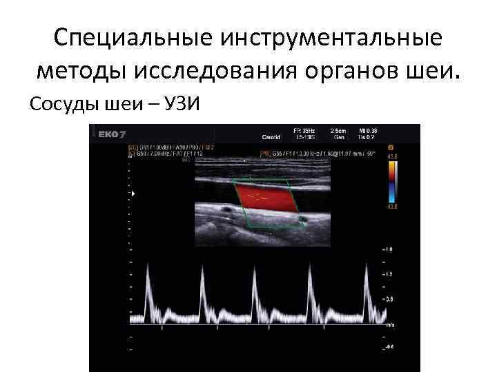 Специальные инструментальные методы исследования органов шеи. Сосуды шеи – УЗИ 