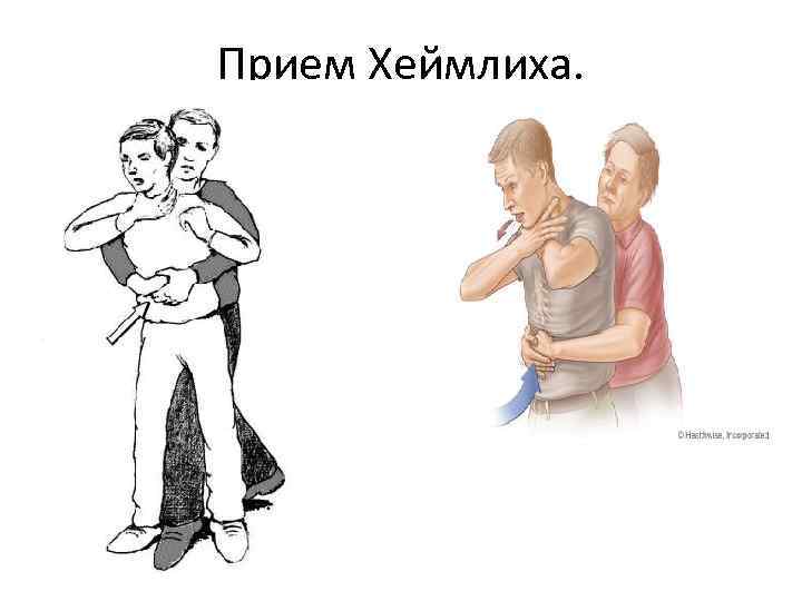Прием Хеймлиха. 