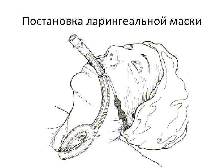 Постановка ларингеальной маски 