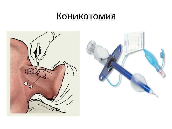 Коникотомия 