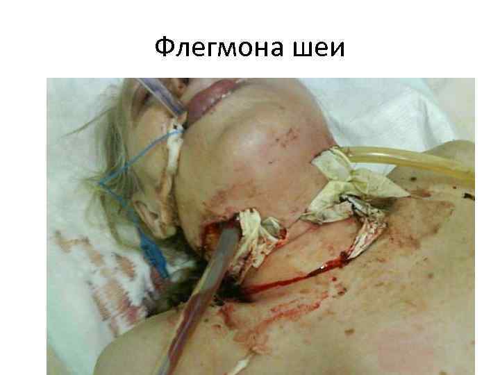 Флегмона шеи 