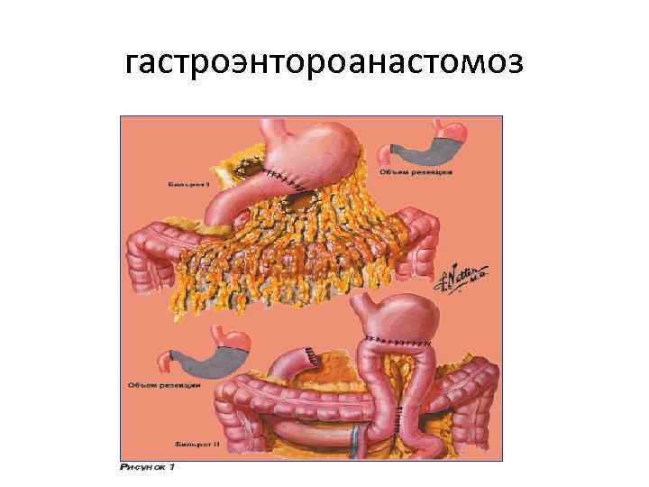 гастроэнтороанастомоз 
