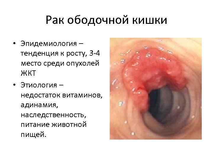 Рак ободочной кишки • Эпидемиология – тенденция к росту, 3 -4 место среди опухолей