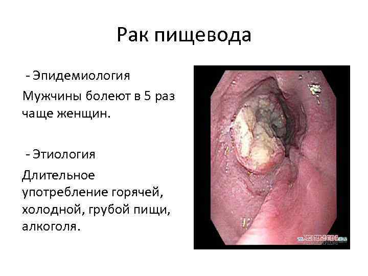 Рак пищевода - Эпидемиология Мужчины болеют в 5 раз чаще женщин. - Этиология Длительное