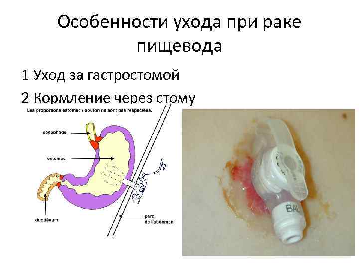 Особенности ухода при раке пищевода 1 Уход за гастростомой 2 Кормление через стому 