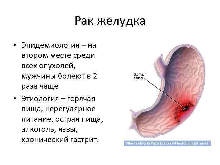 Рак желудка • Эпидемиология – на втором месте среди всех опухолей, мужчины болеют в