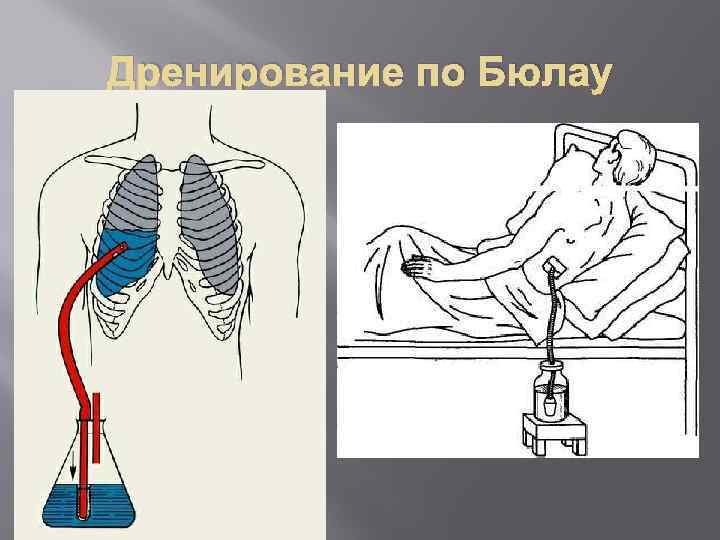 Дренирование плевральной полости по бюлау