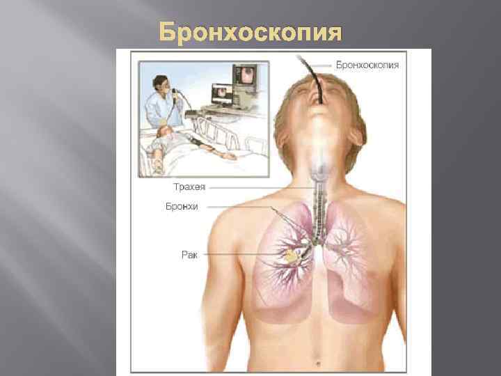 Бронхоскопия легких. Бронхоскопия опухоль трахеи. Бронхоскопия легких при туберкулезе. Бронхоскопия у больных туберкулезом.