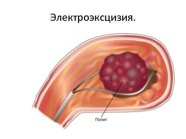 Электроэксцизия. 