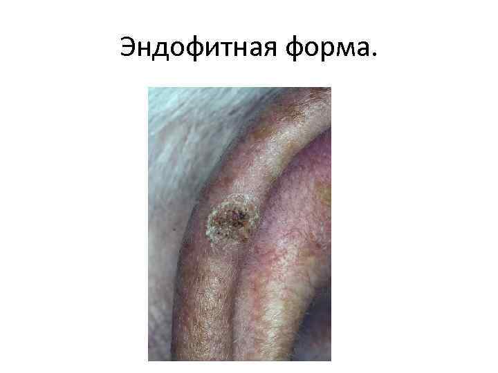 Эндофитная форма. 