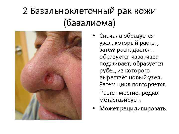 2 Базальноклеточный рак кожи (базалиома) • Сначала образуется узел, который растет, затем распадается образуется