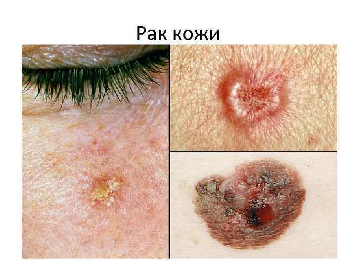 Рак кожи 