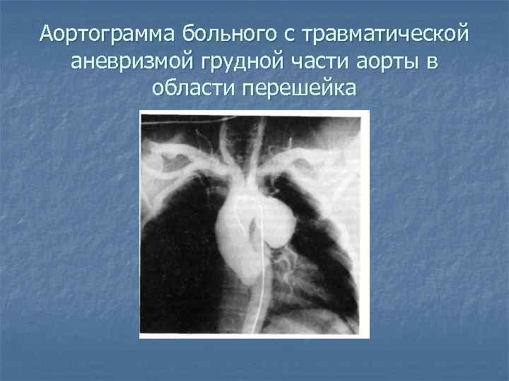 Аортограмма больного с травматической аневризмой грудной части аорты в области перешейка 