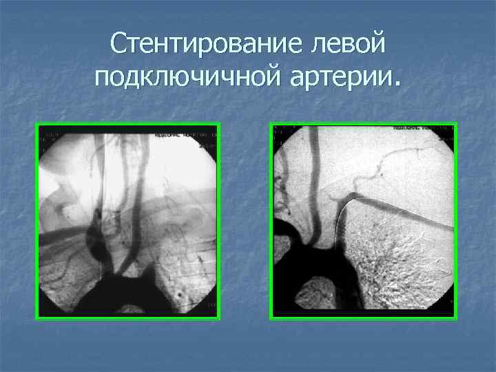 Стентирование левой подключичной артерии. 