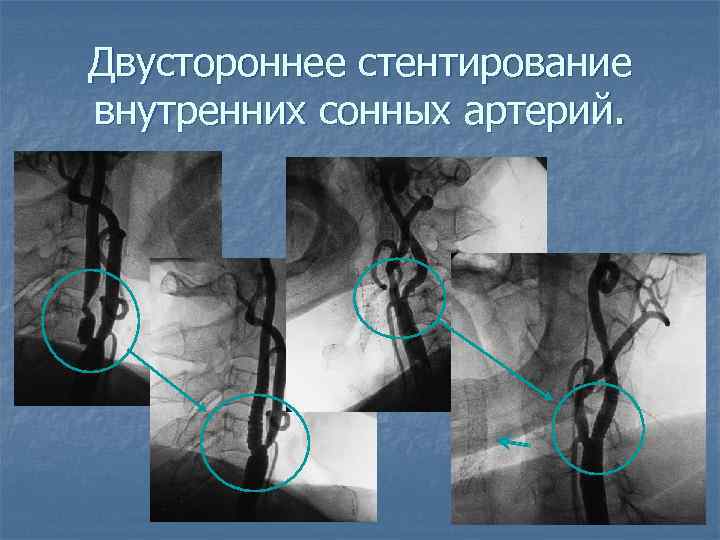 Двустороннее стентирование внутренних сонных артерий. 