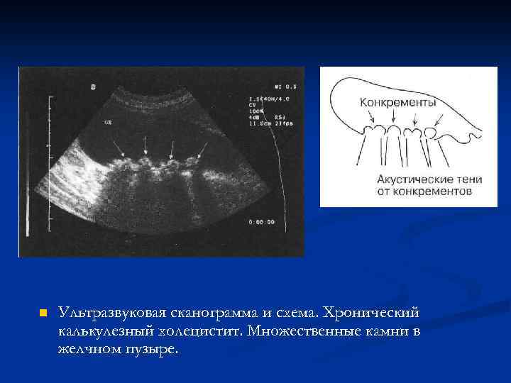 n Ультразвуковая сканограмма и схема. Хронический калькулезный холецистит. Множественные камни в желчном пузыре. 