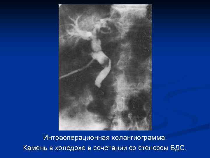 Интраоперационная холангиограмма. Камень в холедохе в сочетании со стенозом БДС. 
