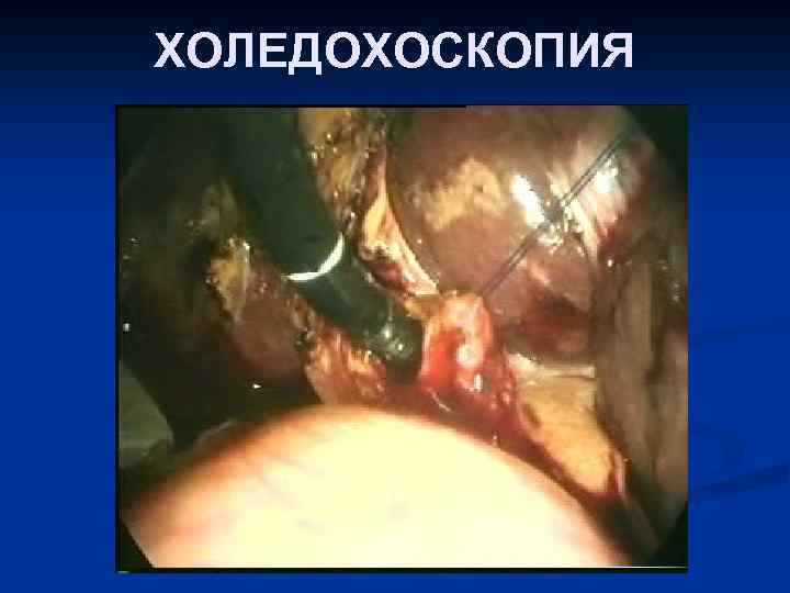 ХОЛЕДОХОСКОПИЯ 