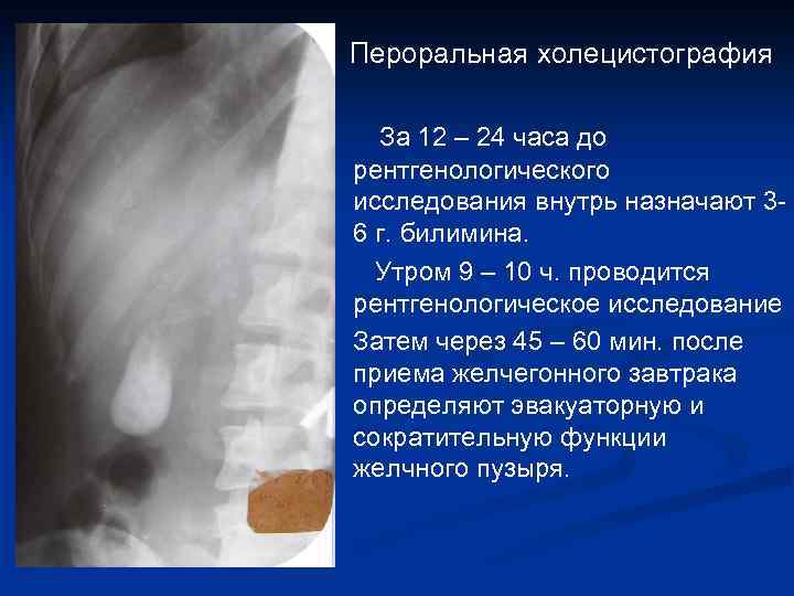 Пероральная холецистография За 12 – 24 часа до рентгенологического исследования внутрь назначают 36 г.