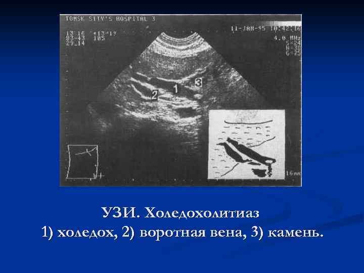 УЗИ. Холедохолитиаз 1) холедох, 2) воротная вена, 3) камень. 