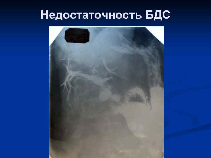 Недостаточность БДС 