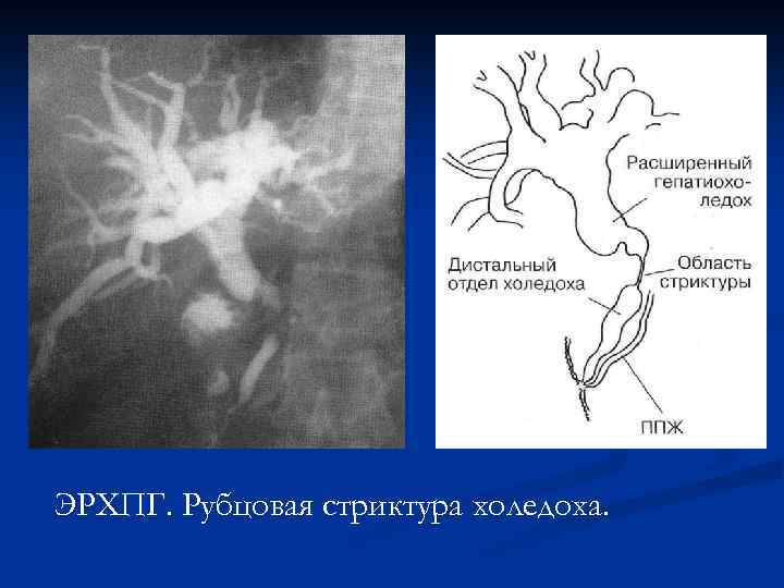 ЭРХПГ. Рубцовая стриктура холедоха. 