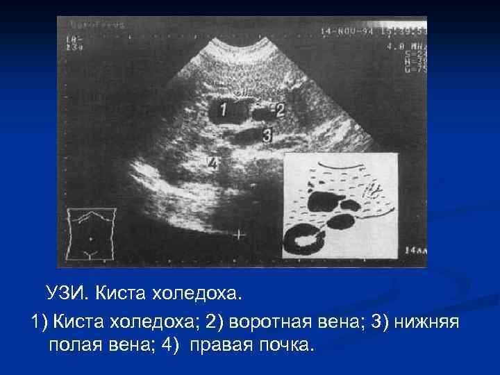 УЗИ. Киста холедоха. 1) Киста холедоха; 2) воротная вена; 3) нижняя полая вена; 4)