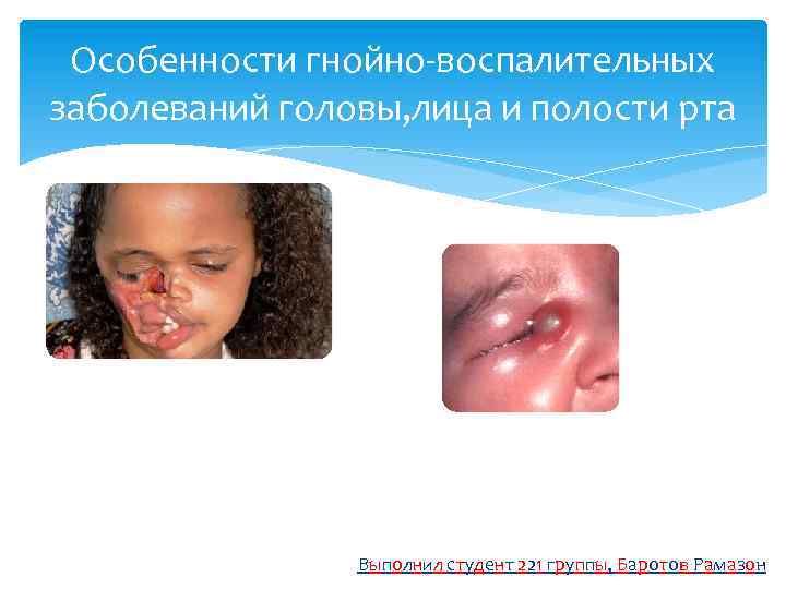 Особенности гнойно-воспалительных заболеваний головы, лица и полости рта Выполнил студент 221 группы, Баротов Рамазон