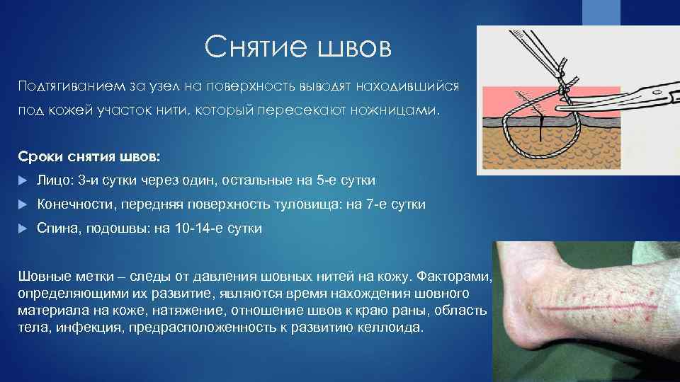 Снятие швов Подтягиванием за узел на поверхность выводят находившийся под кожей участок нити, который