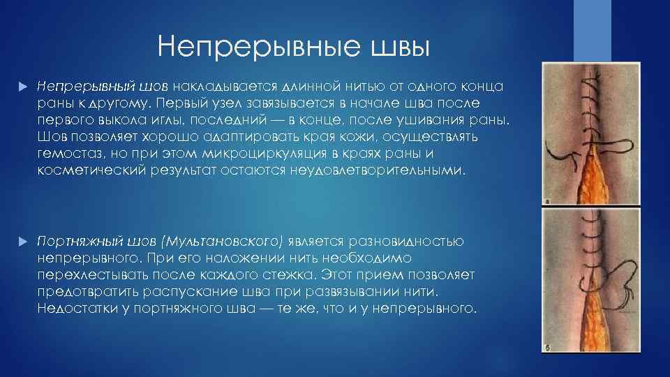 Непрерывные швы Непрерывный шов накладывается длинной нитью от одного конца раны к другому. Первый